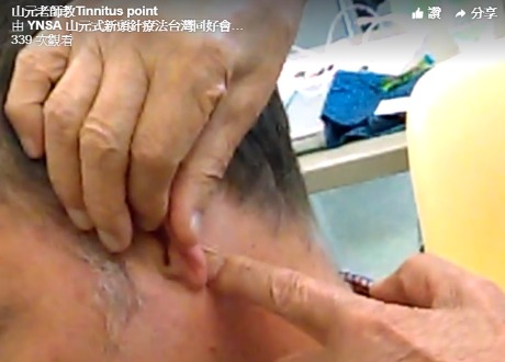 山元老師教Tinnitus point